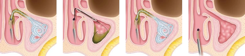 Sinusitis Pediatric Process Sinusitis Pediatric Process