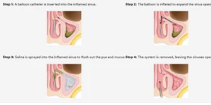 Balloon sinuplasty illustration