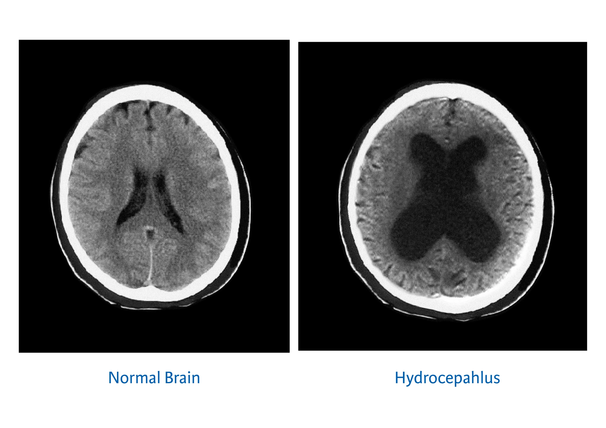 Brain scan images - left is normal brain, right is a brain with diagnosed Hydrocephalus.
