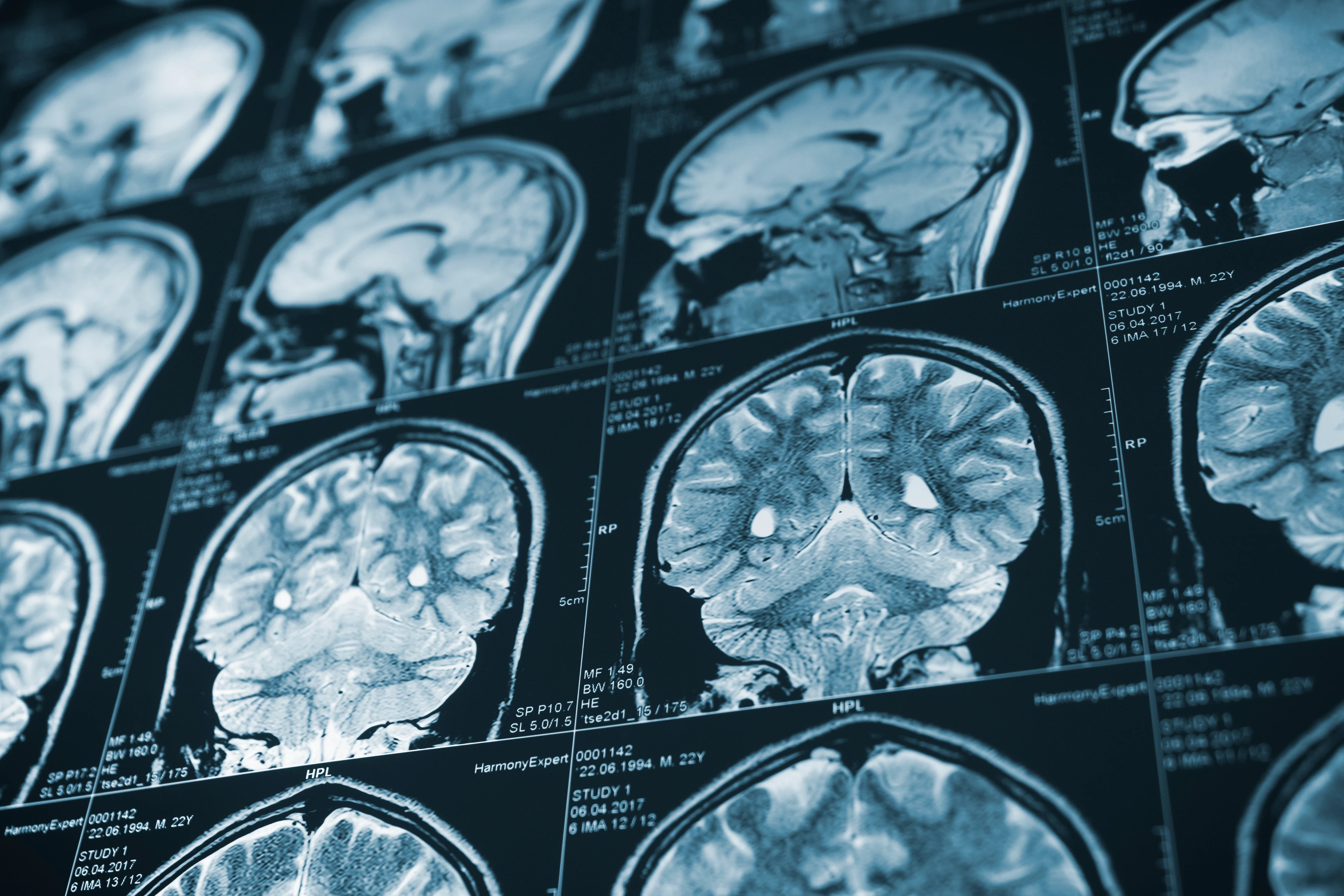 Test results from a brain scan related to NPH.