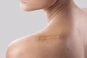 Shoulder with scar