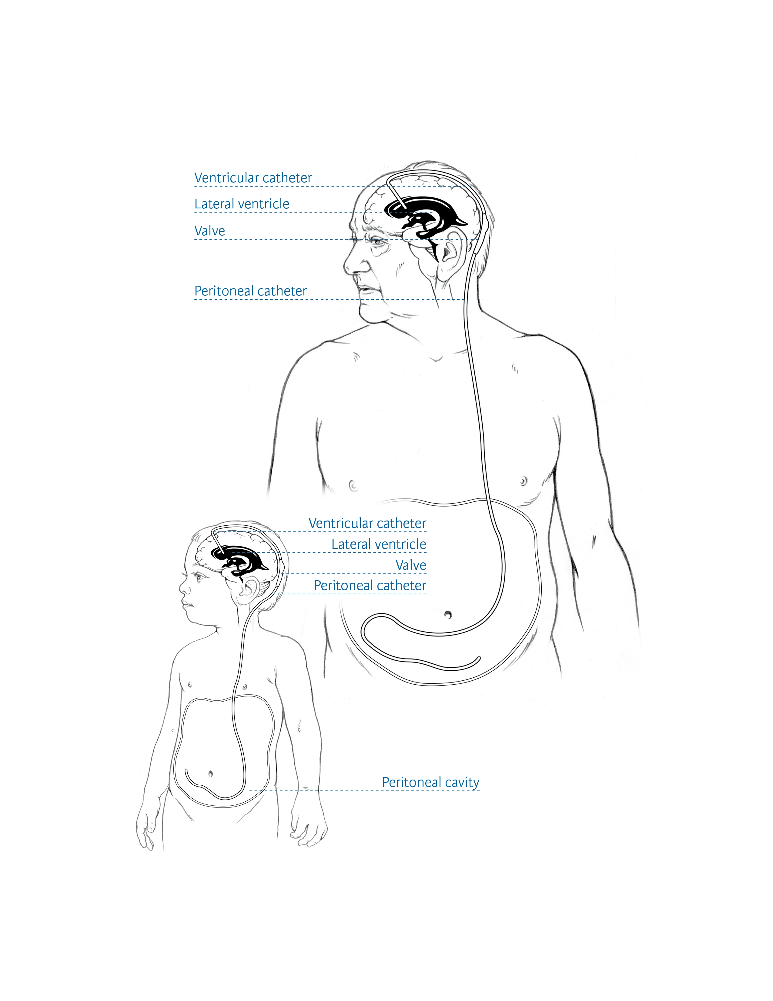 Hydrocephalus diagram