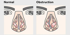 Illustration of the inside of the nose normally and obstructed