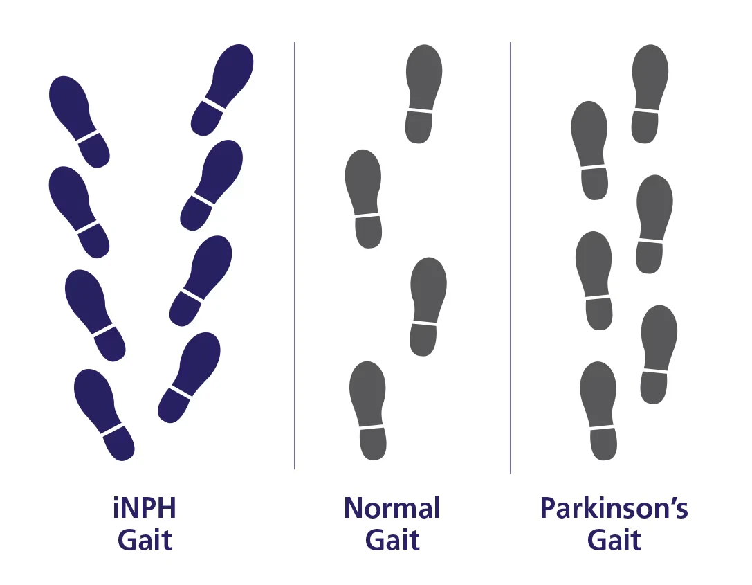 NPH Gait Chart
